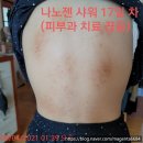 화우요가 | 큰 딸 아토피피부염을 완치시킨 화우나노텍 나노젠pH8.5프리미엄 사용 후기