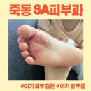 7189 | [대전 죽동 SA피부과] 아기 발 물집 치료 후기 (feat. 곰팡이, 무좀)