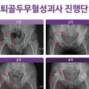 대퇴골두무혈성 괴사 그 원인은 무엇일까 이미지