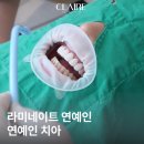 서울예쁜얼굴치과의원 | 선릉역 라미네이트 연예인 무삭제 후기 예쁜 치아 믿어도 될까?