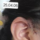 참미소약국 | 공포의 전이개누공(선천성 이루공) 염증 회복 및 수술 후기