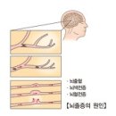 뇌졸중이란 이미지