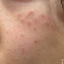 바른정한약국 | egf 효능 피부과 레이저 후 재생크림 연고 가장 빠른 관리법