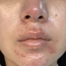 최부걸 | 임산부 피부염 ( 주사피부염 • 지루성피부염 • 임신호르몬 • 임산부 피부트러블 )