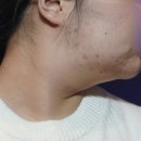 선명한의원 | 당산역 여드름 흉터 치료 후기! feat 리체안한의원