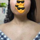 300 | 편평사마귀 제거 일대기_수원 성지 편평사마귀 300개 이상 제거 후 관리, 후기