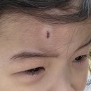 진해물재생센터 설비동 | 아이 이마 흉터 레이저 치료 후기 한강수병원 아이흉터전문병원 비용 관리까지 적은 후기