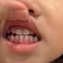 엄마랑 유리드믹스 18-29개월 | 29개월 영유아 구강검진 후기 및 32개월 충치 소견, 불소 도포 및 관리법