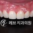 수정기공사 | 신사역 라미네이트, 잘하는 치과의 치료과정과 재료.설명.비용.후기.
