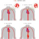대동맥류 (aortic aneurysm) 이미지