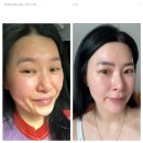 압구정미라클의원 | 퀼실 리프팅 1년 후, 압구정미라클의원 솔직 리뷰