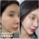 붕붕나라 | 강남피부과 스킨부스터 리쥬엔 시너젯으로 받은 솔직 후기(큐어젯과 차이)