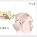그림으로 본 인공와우이식술 - 수술 및 재활 진행단계 이미지