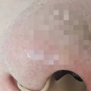 브레싱 | 비강확장기 코골이방지기구 에브레싱 후기