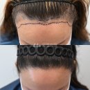 중앙헤어라인 이미지