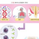 손가락 관절염 류마티스 관절염 (류머티스) 이미지