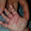 16개월 아기 손가락 습진ㅜㅜ 이미지