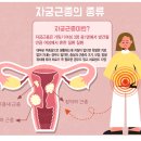 자궁근종, 매년 크기가 커진다면, 치료법은? 이미지