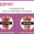 칸디다 질염 재발 원인 및 예방법 이미지