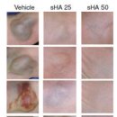 전립선 암을 치료하는 Sulfated Hyaluronic Acid 이야기 이미지