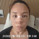 순정약국 | 수술 기증늑 실리콘 콧대 코끝 긴코 화살코 비순각교정 수술 리얼 후기 - 수술 전 과정~3일차(정보 공유 O)
