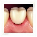 더이로운치과병원 | 양산 임플란트 수술 후 증상 부작용, 알고 대비하세요 (더이로운치과 병원)