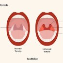 편도선염 원인 편도 부었을때 대처법 목 부음 통증 음식 이미지