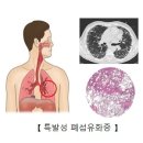 희귀난치성질환 특발성폐섬유증 환자는 살고 싶다. 이미지