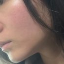 다나아 한의원 | 홍조, 지루성, 주사 피부염, 아토피 진단명이 의사마다 다 다른 피부염 한의원 후기