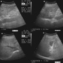 hepatic cyst & morderate fatty liver 이미지