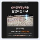 스마일 | 스마일라식 당일 후기 요약정리해 보자면