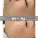 포항왁싱/라이콘포항지사:)페이스왁싱은 단연 풀 페이스 왁싱!