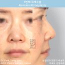 콧구멍 비대칭, 숨쉬기 힘든 코 :: 귀연골 코 재수술 후기 【Dr. 아베크 코성형】