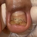 레푸스앤스타일 일산장항점 | 일산 내성발톱 서서 일하는 직업의 말린 발톱 후기