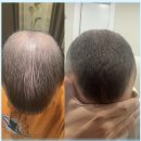 세종연합의원 | 세종 프로페시아 그리고 미녹시딜 탈모치료