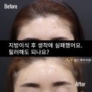 삼성동피부과 골드제이의원 Q&amp;A 지방이식 생착에 실패했을 때 이마필러 해도 되나요??