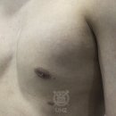 김해비뇨기과 비대칭여유증 짝가슴 해결방법