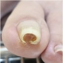233-운정3-233 | 파주 운정 내성발톱 심하게 파고들던 발톱 해결 금손네일