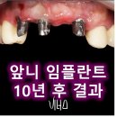 메탈비너스 | [압구정 앞니 치과] 앞니 임플란트 9년 후 후기