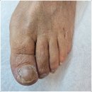 포쉬네일안산고잔점 | 안산내성발톱 발톱무좀 한번에 관리받기 오벨리네일 포쉬네일 동성제약 풀리메디 족보있는그녀들 안산점