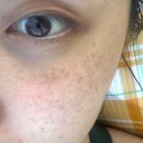 압구정찜질방사우나 | R ep.01 | [압구정 루나의원] 루비레이저 성지 시술 내돈내산 후기 ✨