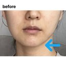 민승기브이라인치과의원 | 안면비대칭 교정기 가격 후기, 이 3가지 꼭 확인하세요!