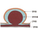 위장관 기질적 종양 (Stomach GIST) 이미지