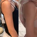 서울에스티셀의원 | 유에이치셀 서초 UHCELL 바디패키지 솔직후기 드레스라인 관리 제대로 받은 날