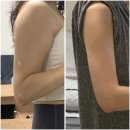 공지로 3L | [공지] 유라인클리닉 지방분해주사 팔뚝컷주사 5회차 내돈내산 솔직리뷰
