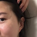 기승한의원 | 편평사마귀 무제한 성지에서 말끔하게 지워낸 솔직한 후기