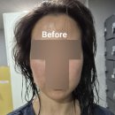 히어로 | 논현동피부과_BBL 히어로 리프팅 비비엘리프팅 후기