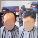 광주 가발 전문점 다온헤어 김호증모가발 자신감 되찾기