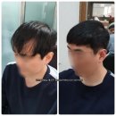 인천증모술 남자 M자탈모 헤어증모술 가격 리얼후기