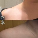 유닛뷰티 | [후기] 바디보톡스후기 | 승모근 보톡스 양쪽어깨에 100유닛씩 맞은후기 | 맞은지 3일째된 후기